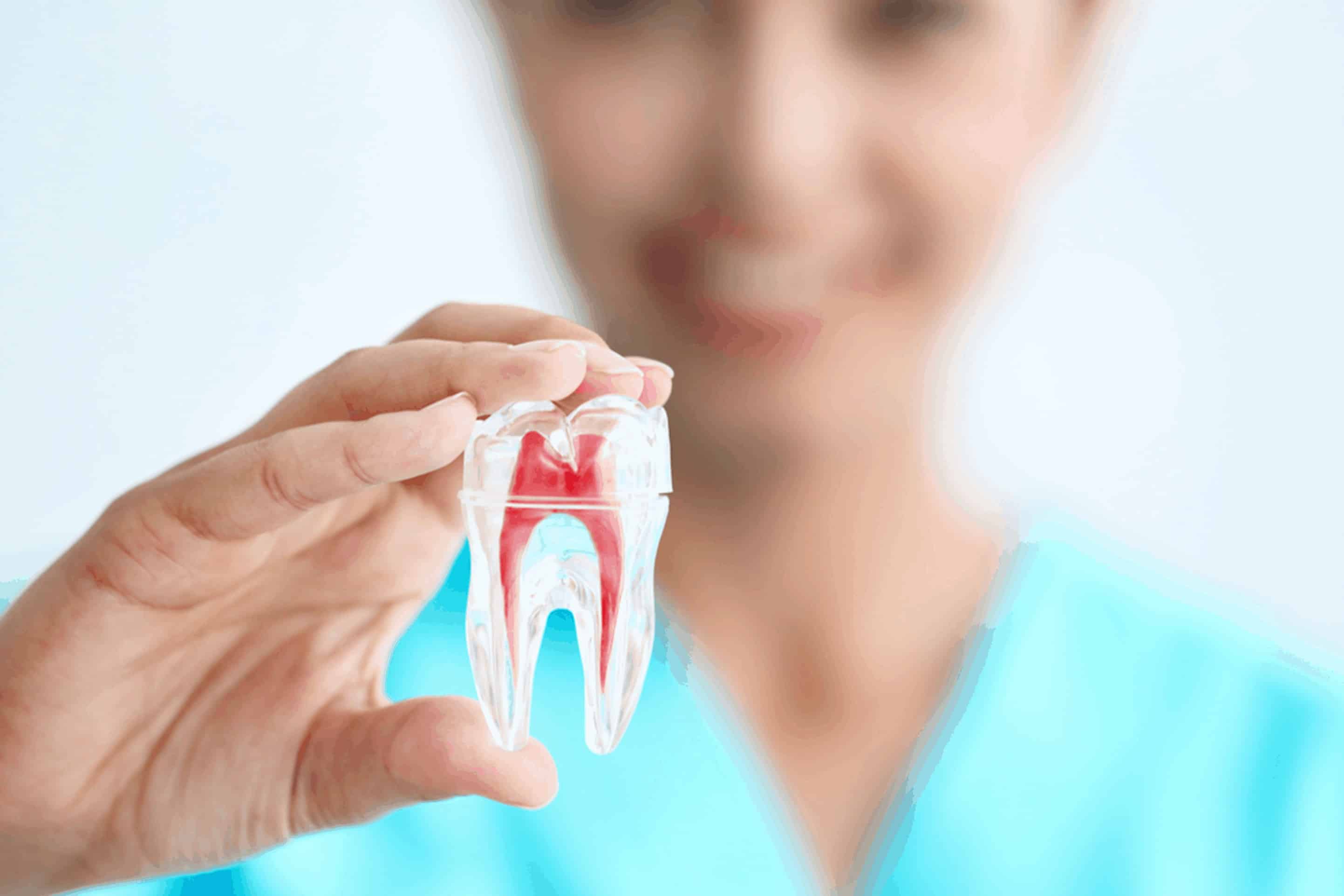 Root Canal Kissimmee