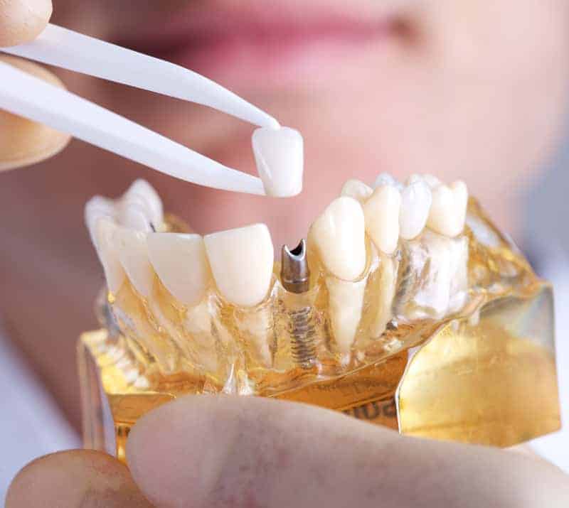 dental implants in kissimmee
