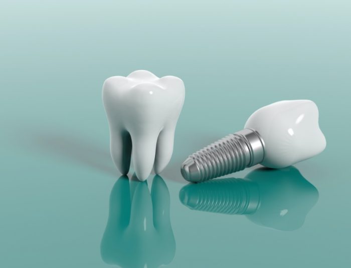 complications that can occur after dental implant surgery