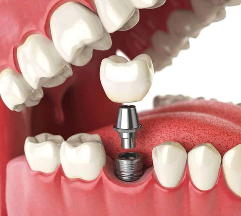 dental implants service