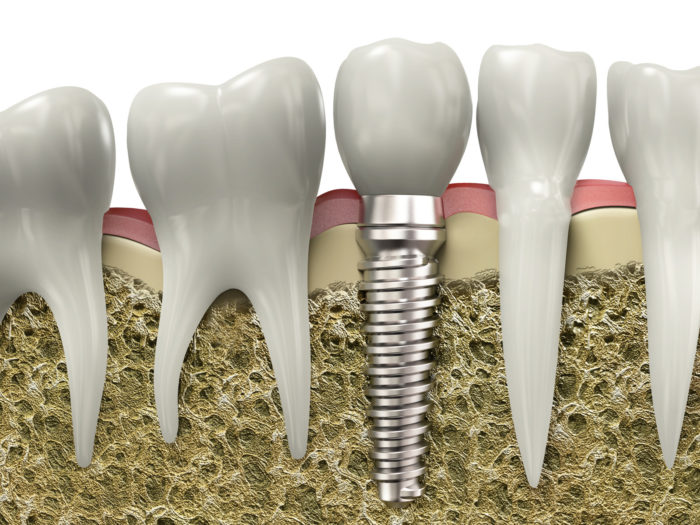 factors affect the success of dental implants