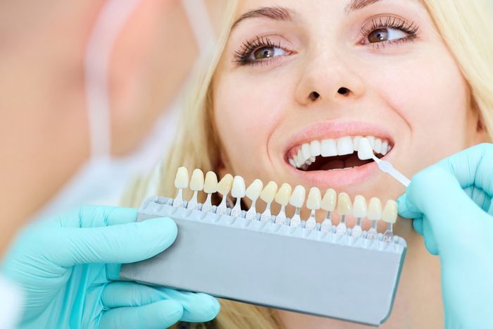 professional vs at-home teeth whitening