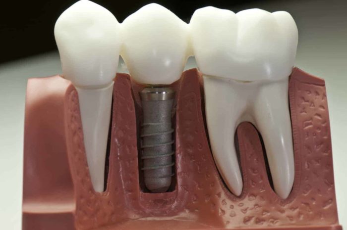 well guarded secrets about dental implants