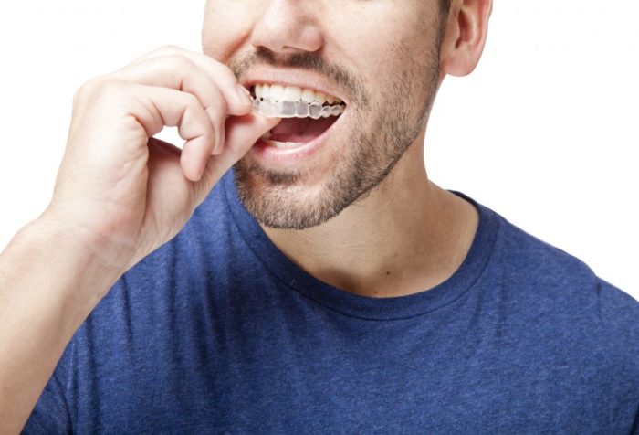 why adults are choosing invisalign for straighter teeth