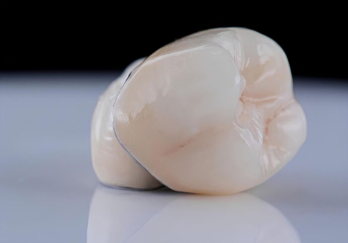 What Are Porcelain Crowns and When Do You Need One?