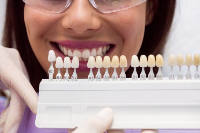 What Are Porcelain Veneers and How Do They Improve Your Smile?