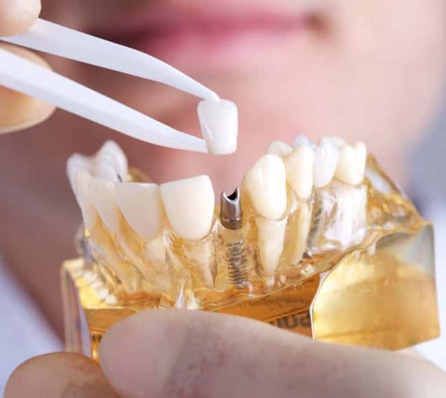 dental-implants-near-kissimmee dental implants near kissimmee