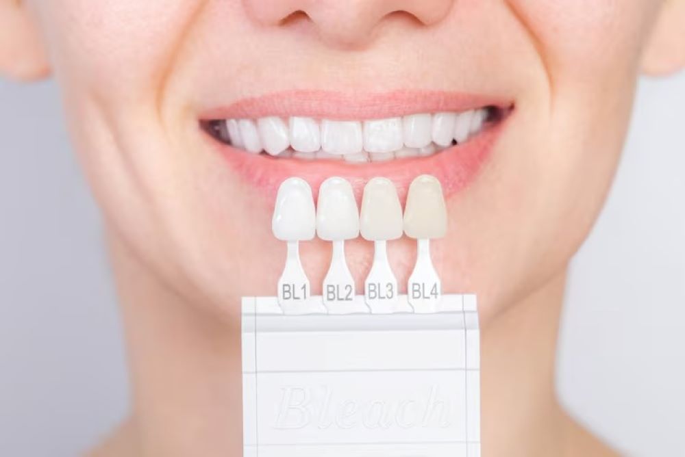 Caring for Your Veneers: Maintenance Tips