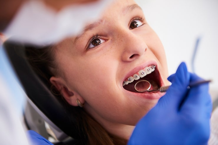 How braces treat crowded teeth and alignment issues