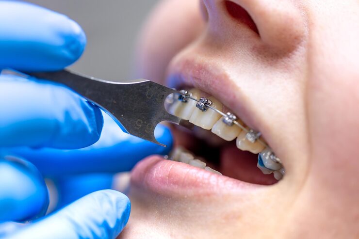 How braces help fix jaw pain and bite problems